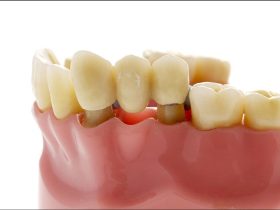 Cost of bridge teeth