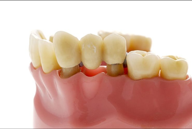 Cost of bridge teeth